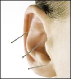 Ohrakupunktur